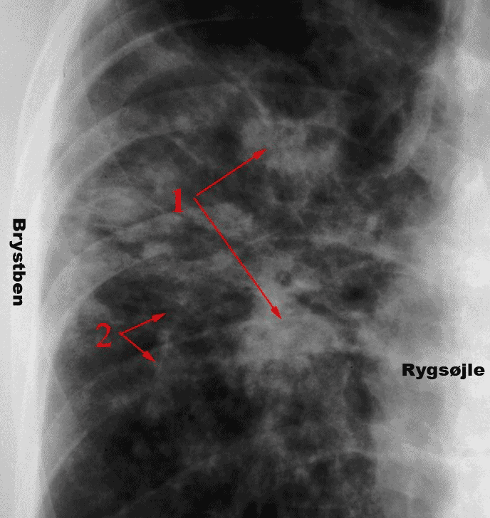 x-ray lungesarcoidose